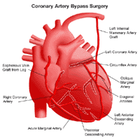 Illustration of the anatomy of the heart following coronary artery bypass surgery 