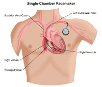 Illustration of a single-chamber pacemaker