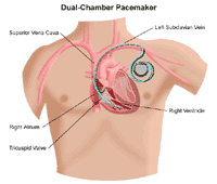 Illustration of a dual-chamber pacemaker