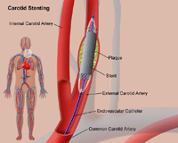 Illustration of carotid stenting procedure
