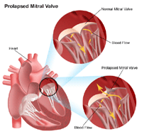 Illustration of a prolapsed mitral valve