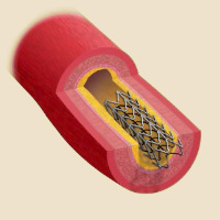 Illustration of a stent